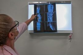 Redução nos atendimentos de saúde por acidentes de trânsito reflete ações integradas do governo de RO