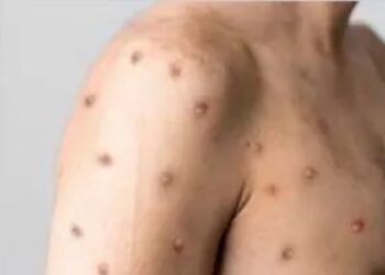 CUIDADOS: Governo de RO apresenta atualização sobre casos de Mpox em Porto Velho e reforça medidas preventivas