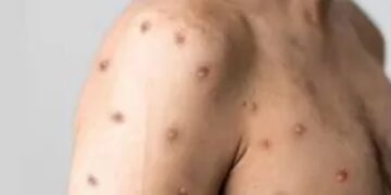 CUIDADOS: Governo de RO apresenta atualização sobre casos de Mpox em Porto Velho e reforça medidas preventivas