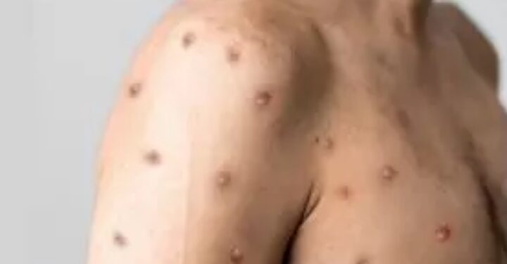 CUIDADOS: Governo de RO apresenta atualização sobre casos de Mpox em Porto Velho e reforça medidas preventivas